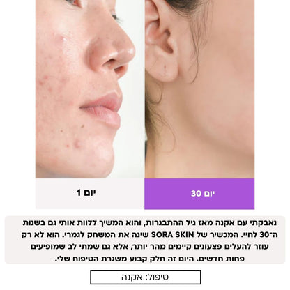 Sora Skin – מכשיר אנטי-אייג'ינג להרמה, מיצוק וחידוש העור