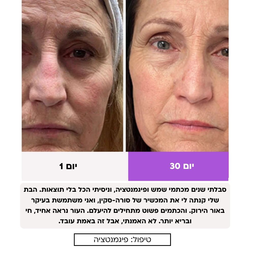 Sora Skin – מכשיר אנטי-אייג'ינג להרמה, מיצוק וחידוש העור